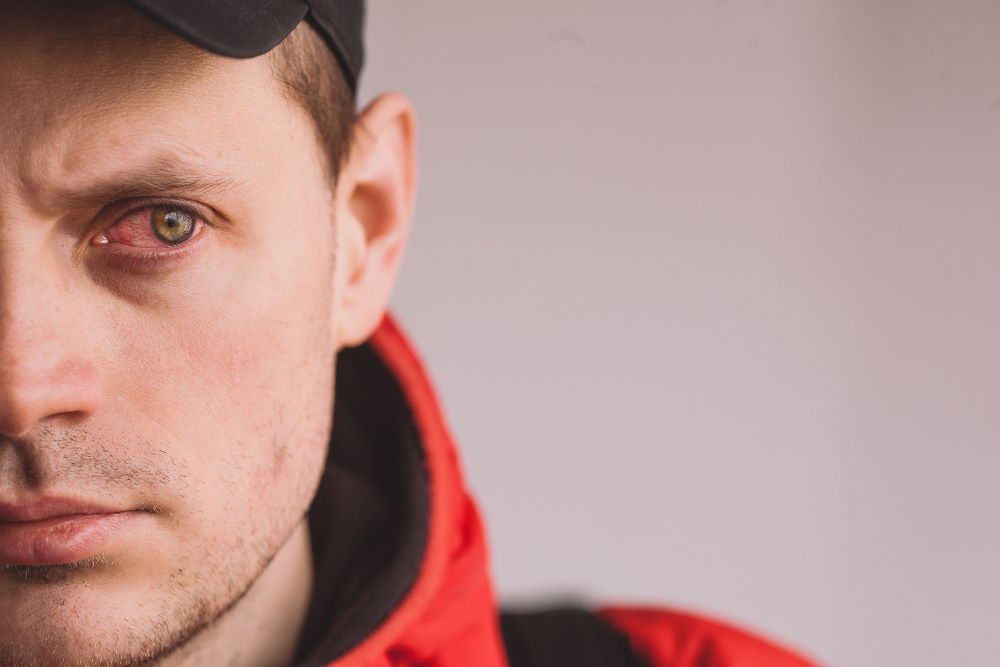 Pink Eye: Causes, Symptoms, and Treatment